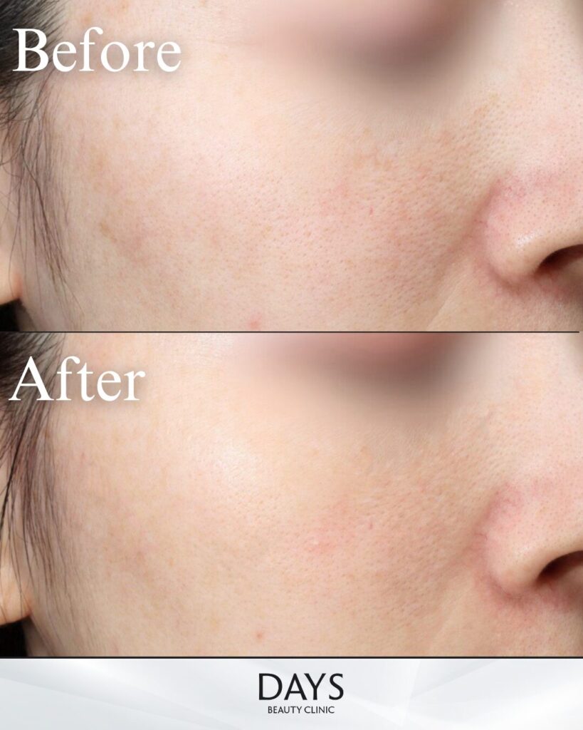 ルメッカピーク　症例　20代女性