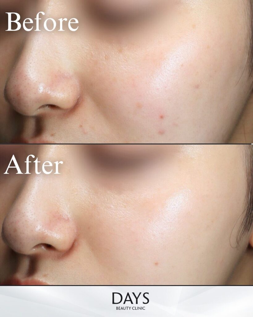 ルメッカピーク　症例　20代女性