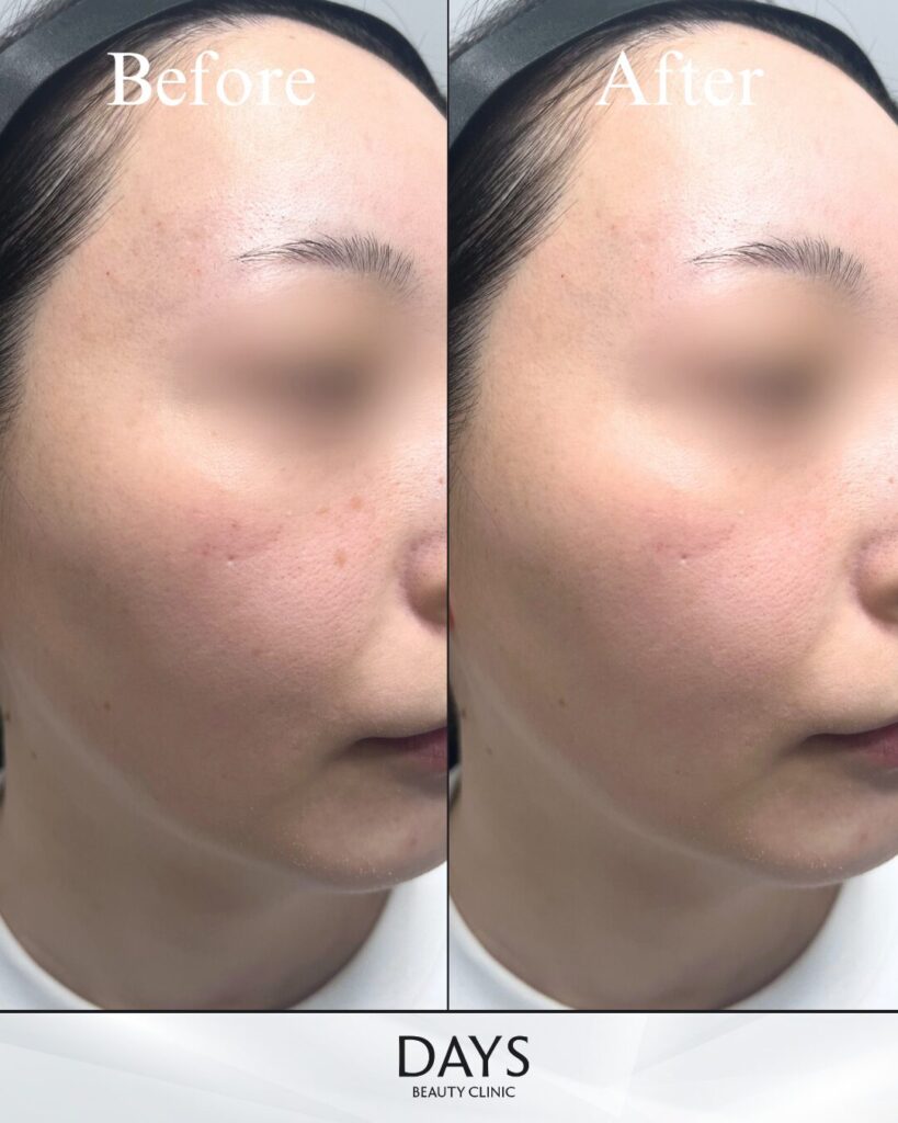 ルメッカピーク　症例　20代女性