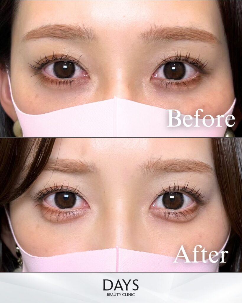 涙袋ヒアルロン酸　症例　20代女性