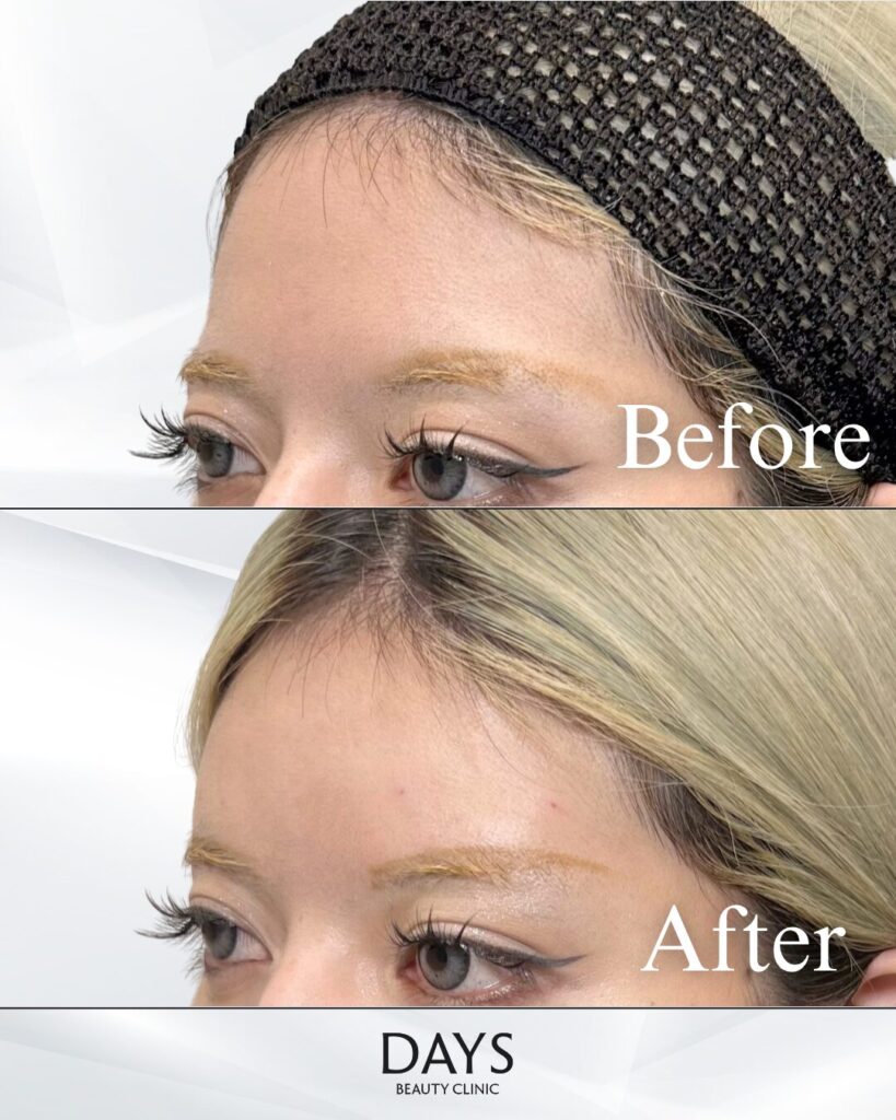 額ヒアルロン酸　症例　20代女性