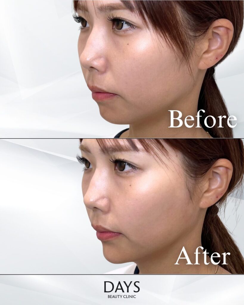 貴族/顎ヒアルロン酸　症例　20代女性