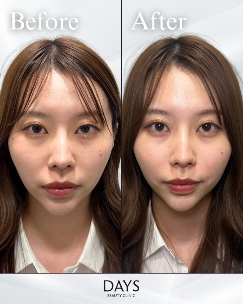 鼻翼基部のヒアルロン酸　症例　20代女性