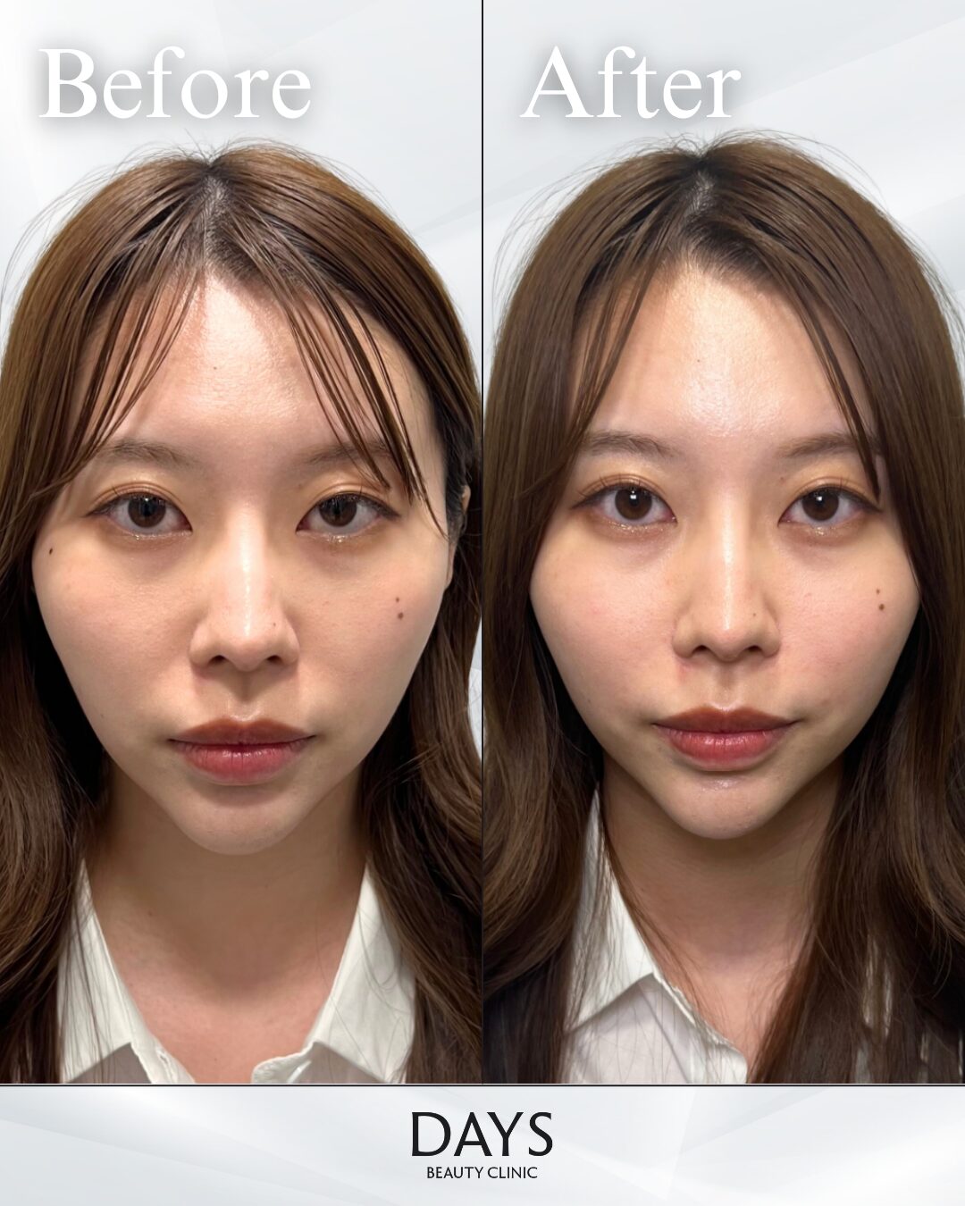 鼻翼基部のヒアルロン酸　症例　20代女性