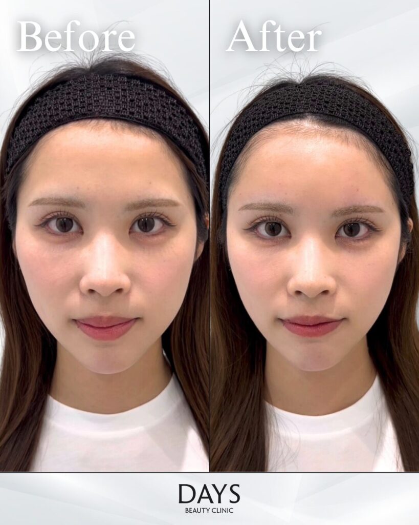 額/こめかみ/頬コケヒアルロン酸　症例　20代女性