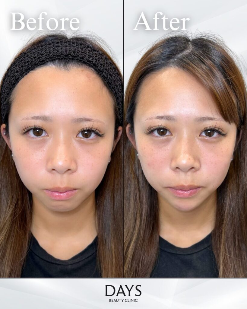 顎ヒアルロン酸　症例　20代女性