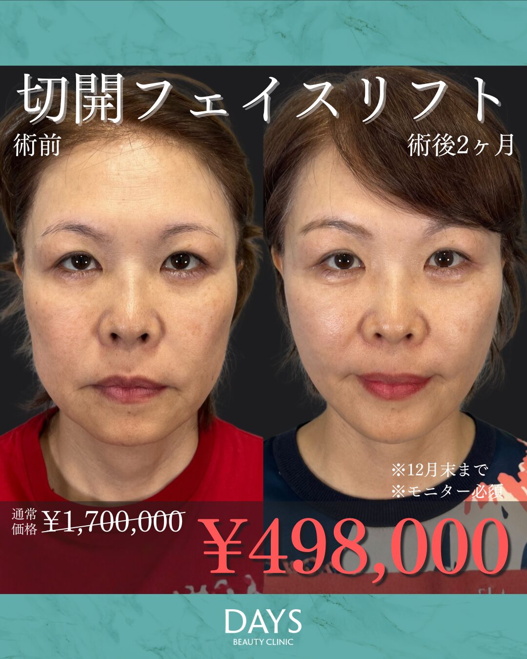 フェイスリフト 2512