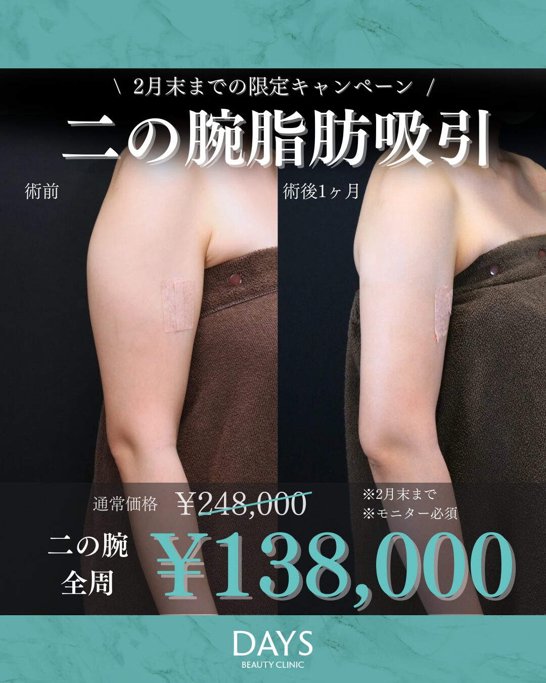 二の腕脂肪吸引 2602