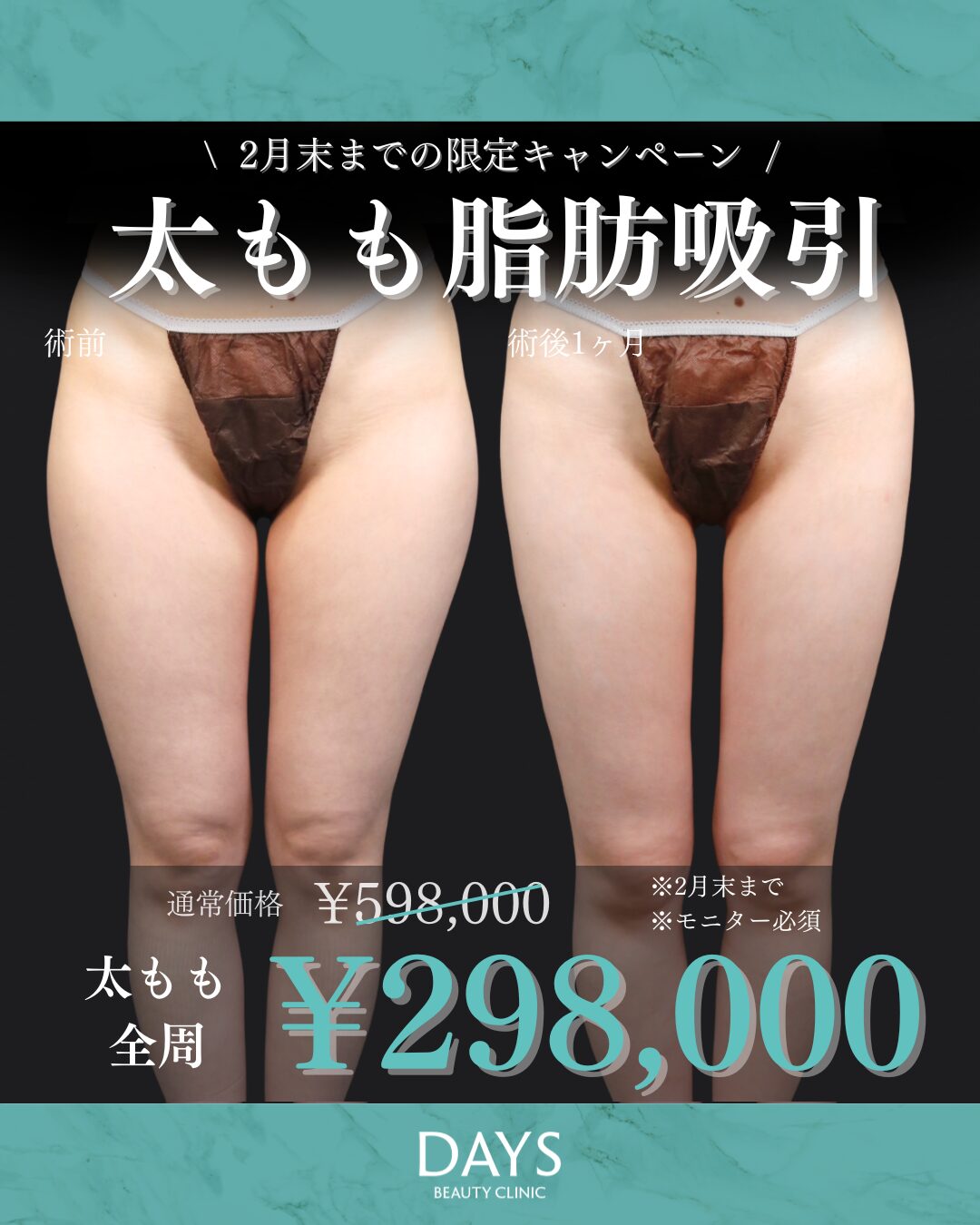 太もも脂肪吸引 2602