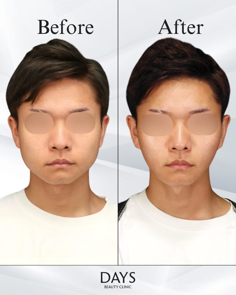 小顔　症例　20代男性