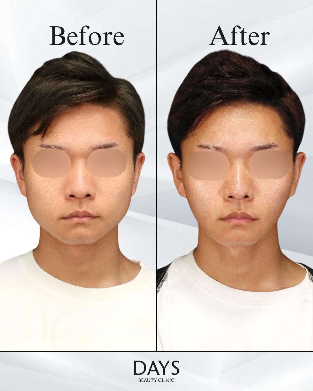 脂肪吸引、バッカル、糸リフト