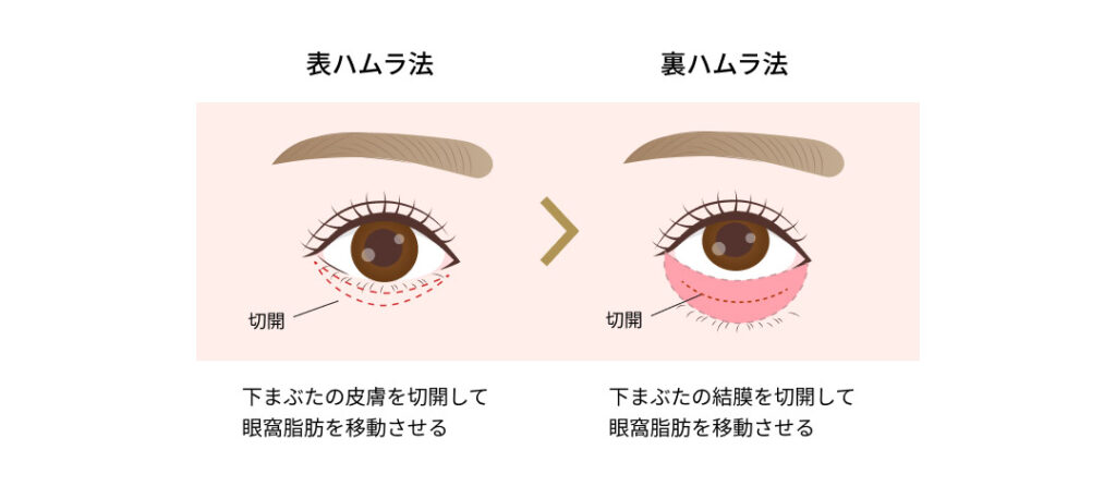 裏ハムラ法イメージ