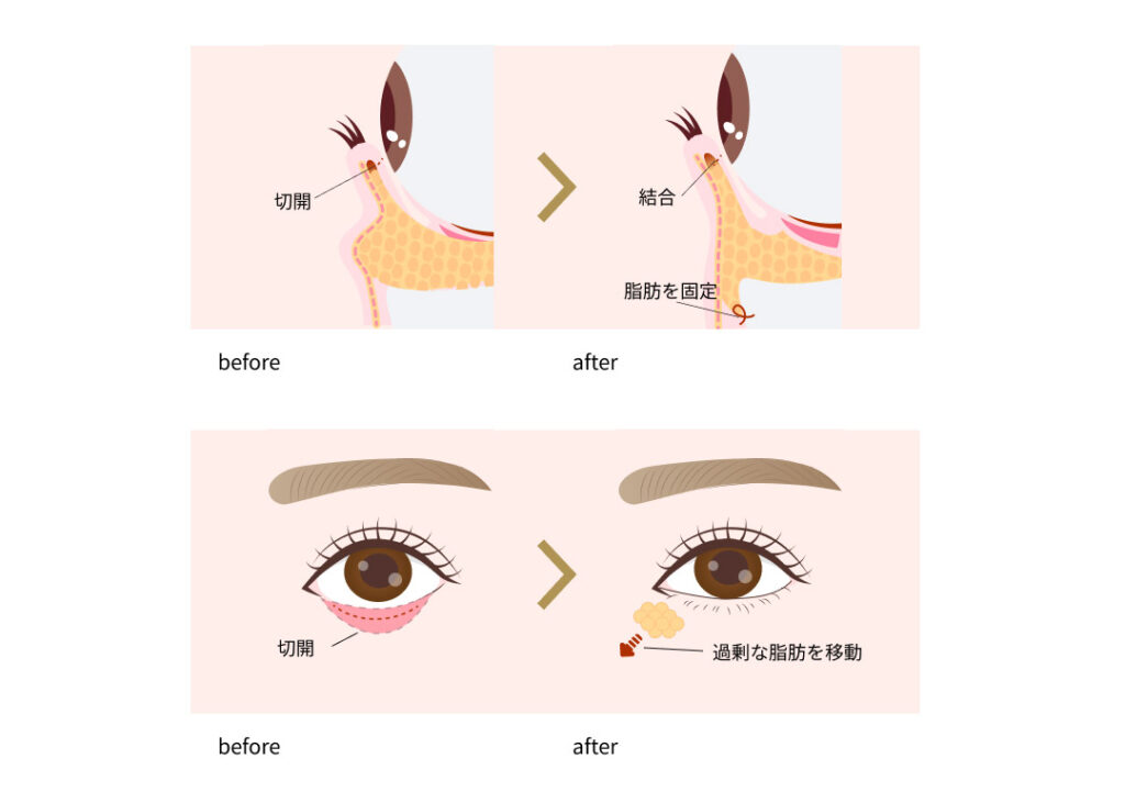 裏ハムラ法の施術内容イメージ