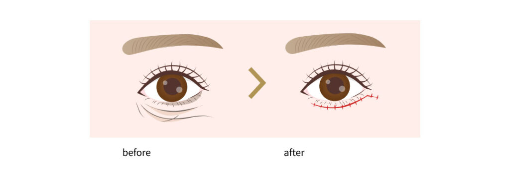 表ハムラ法イメージ