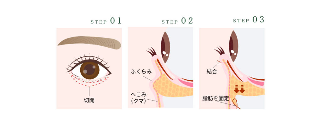 表ハムラ法の施術ステップ