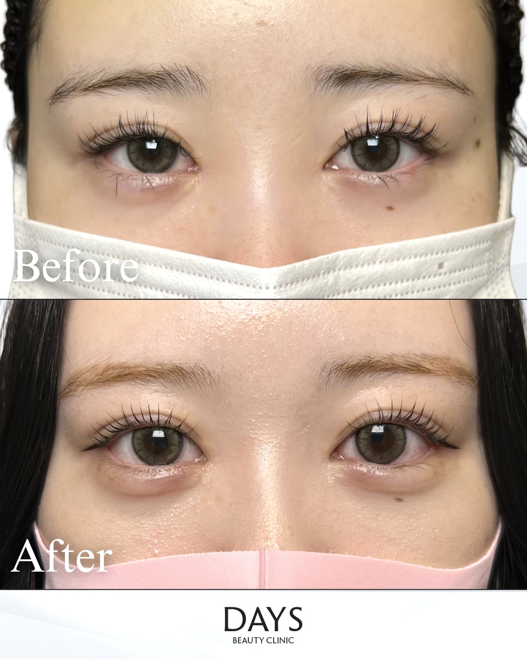 グラマラスライン形成　症例　20代女性