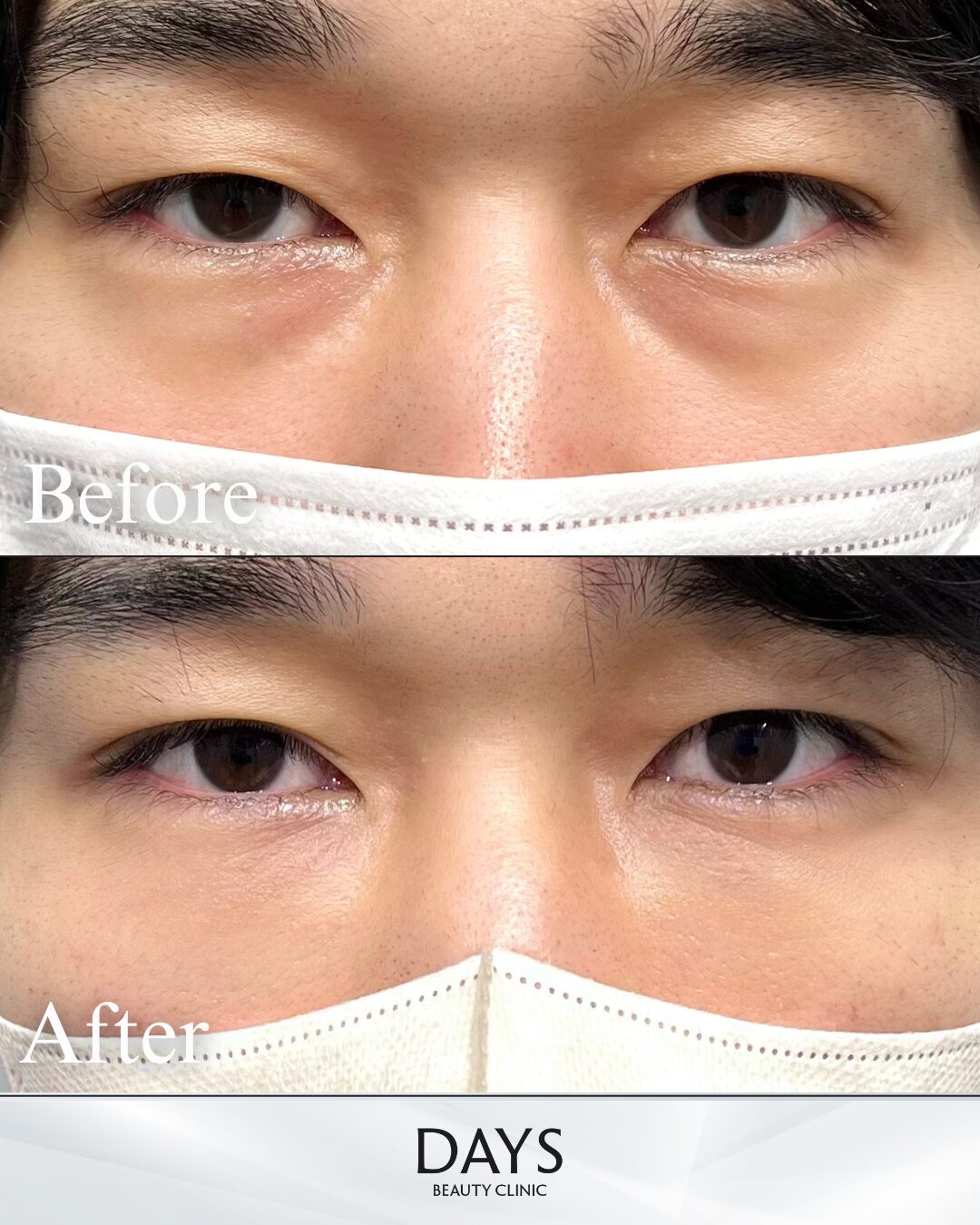 クマ取り　症例　20代男性