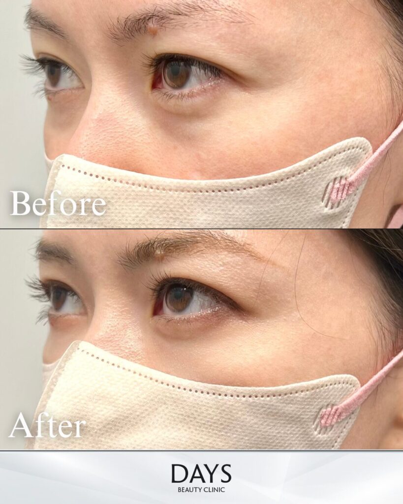 裏ハムラ　症例　30代女性