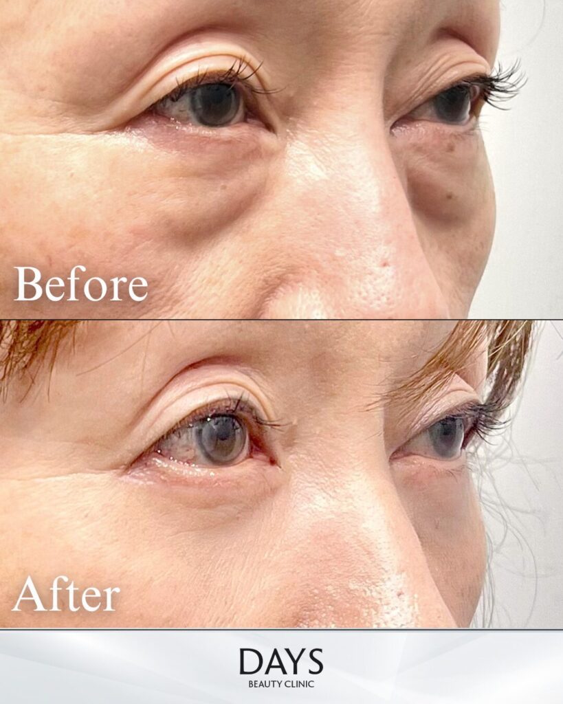 表ハムラ　症例　50代女性