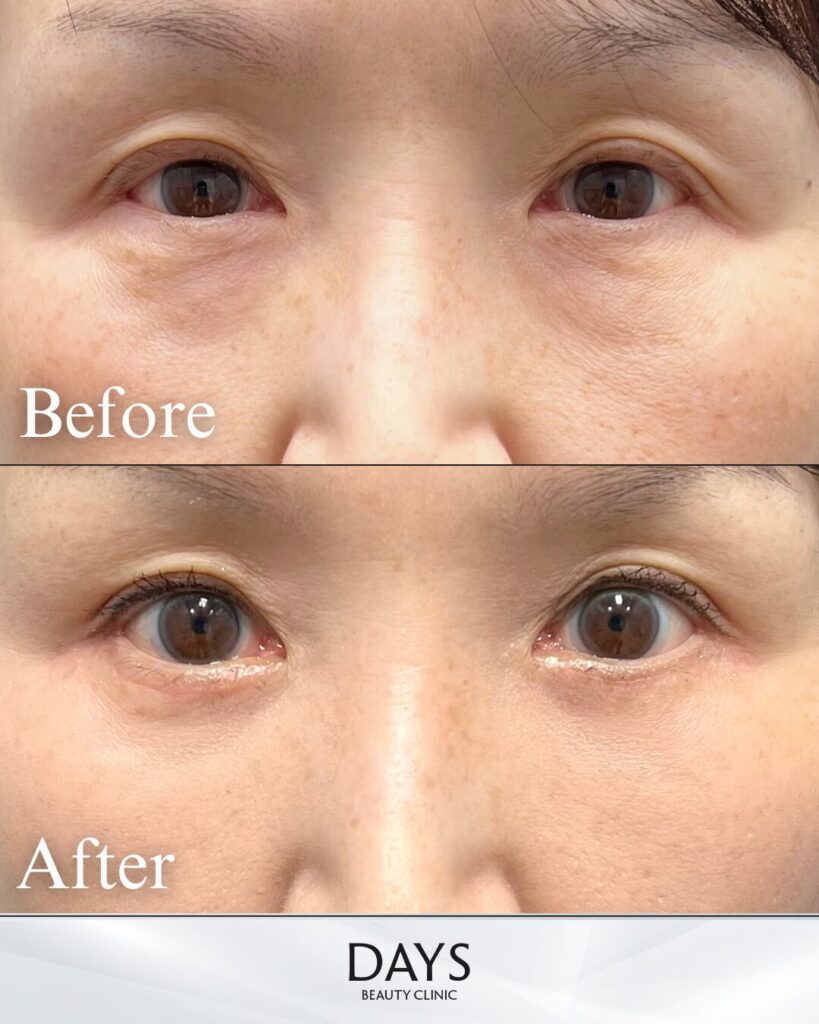 表ハムラ　症例　50代女性