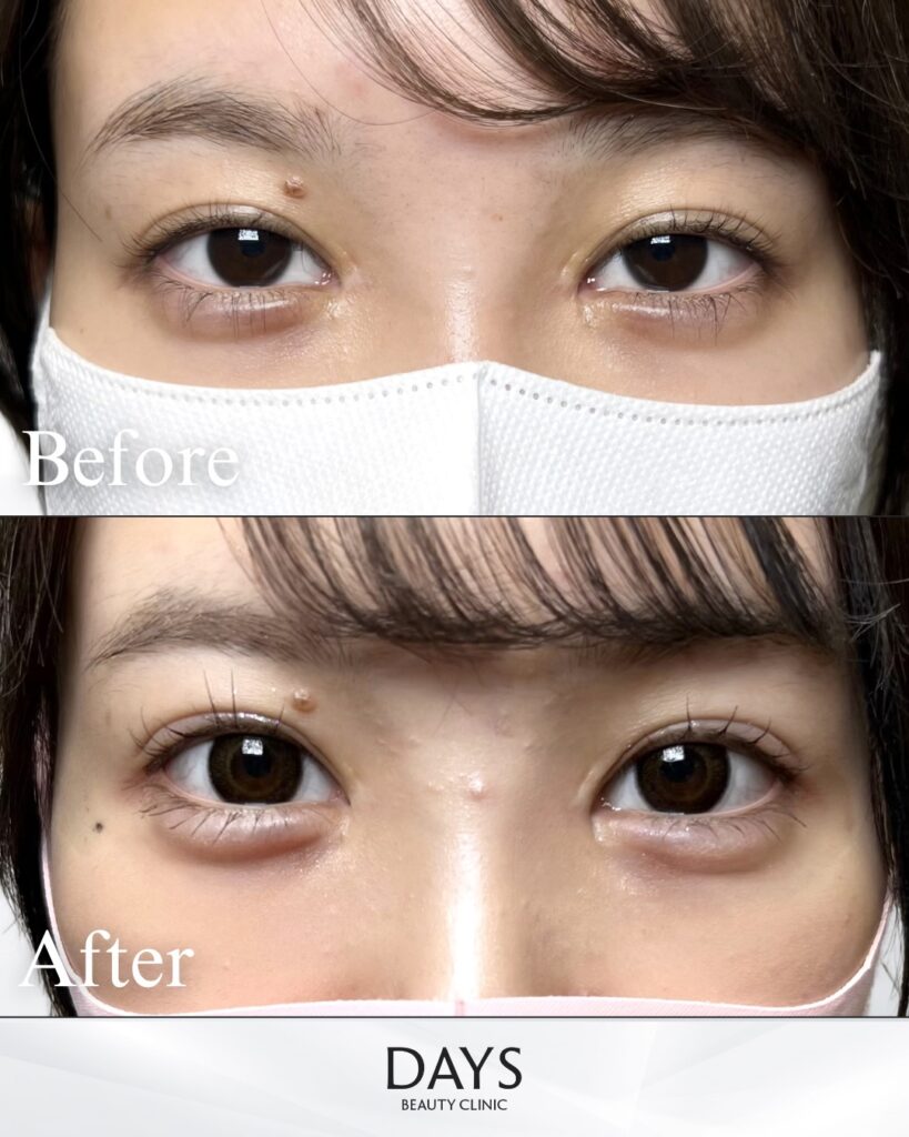 グラ　目尻　タッキング　症例　２０代女性