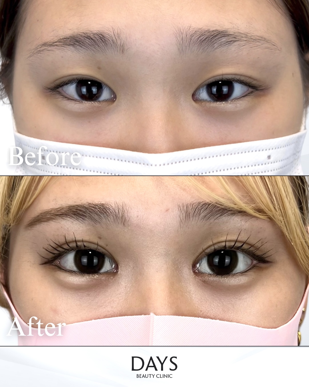 グラ　目尻　二重　目頭　症例　20代女性