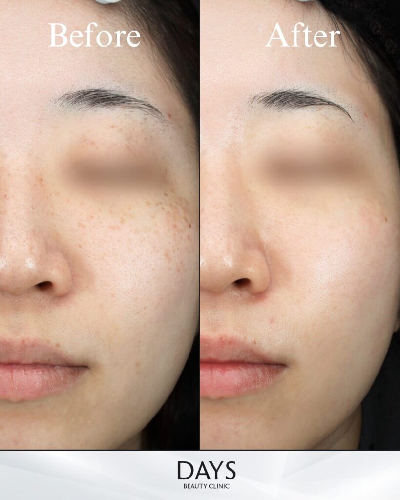 ルメッカピーク　症例　20代女性