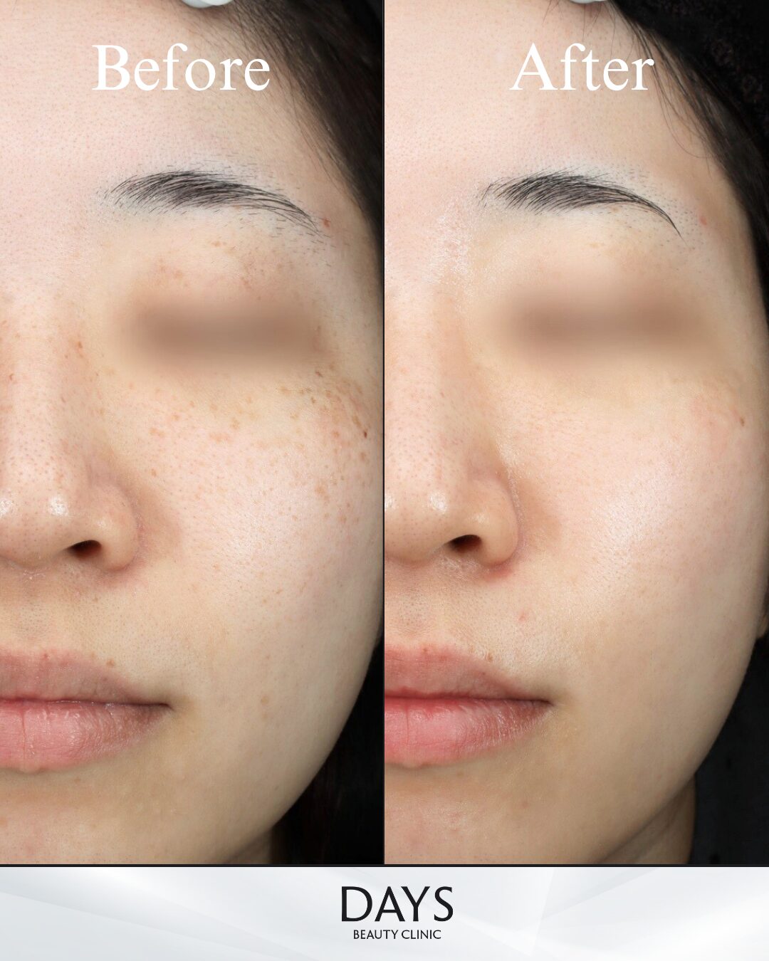 ルメッカピーク 症例 20代女性