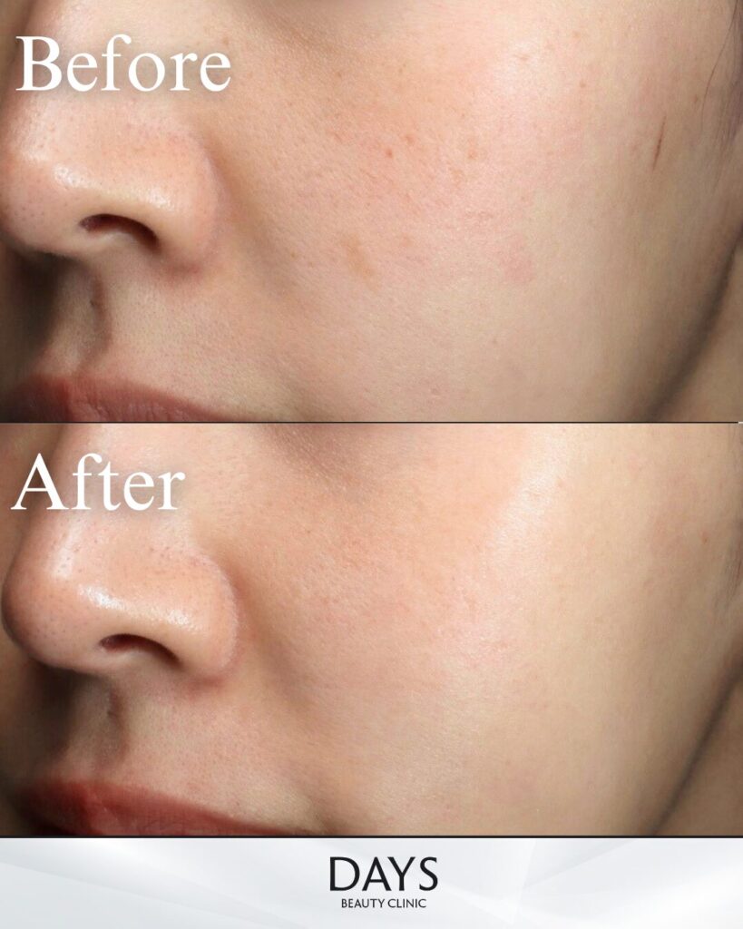 ルメッカピーク　症例　20代女性