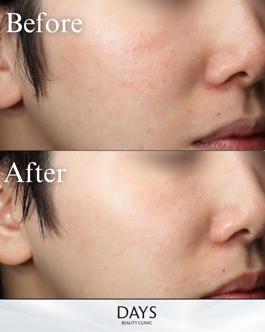 ルメッカピーク 症例 20代女性