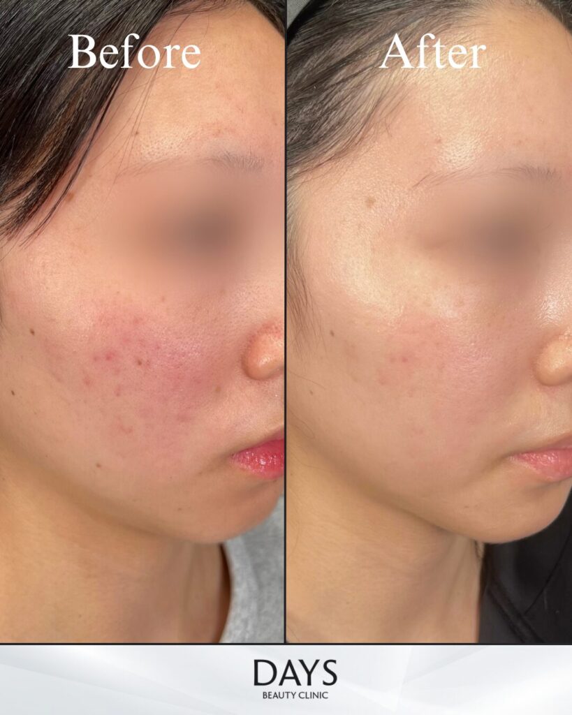 ルメッカピーク　症例　20代女性