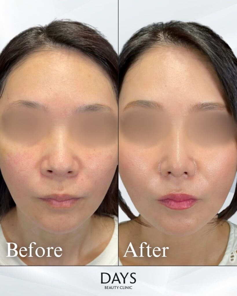 鼻施術　症例　20代女性