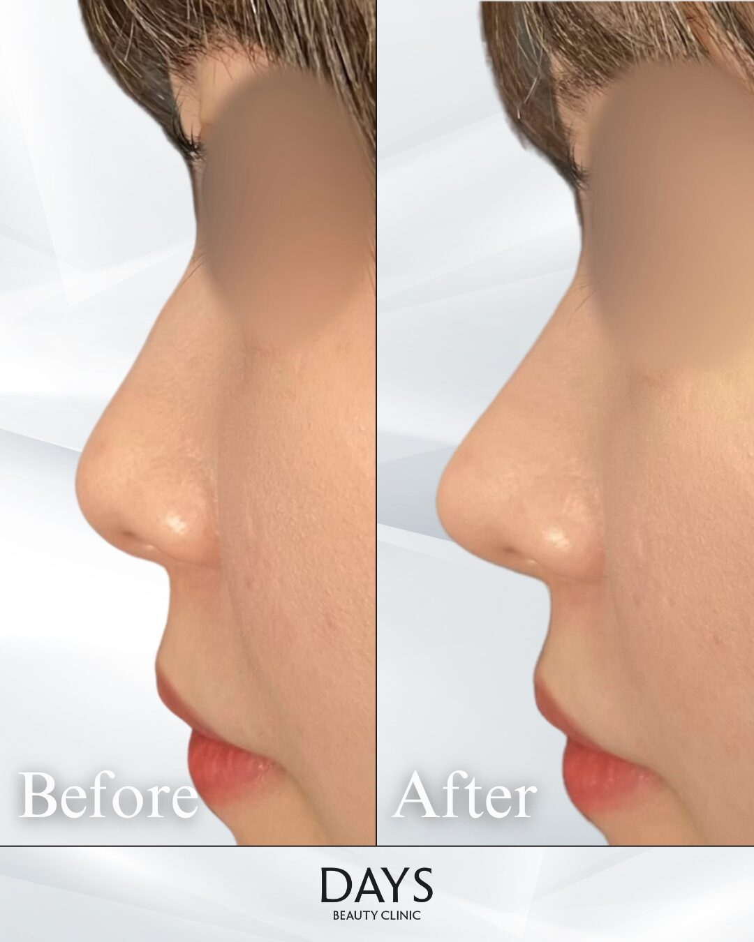 鼻施術　症例　２０代女性