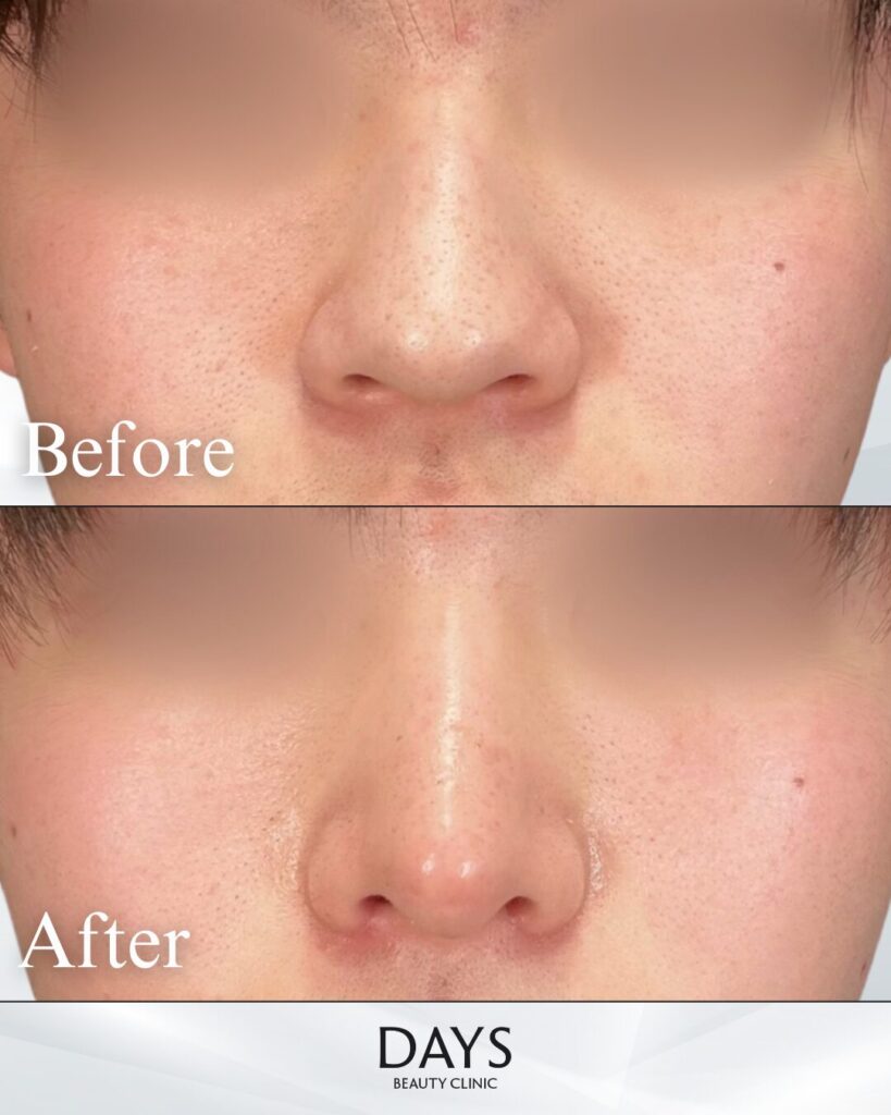 鼻施術　症例　20代男性