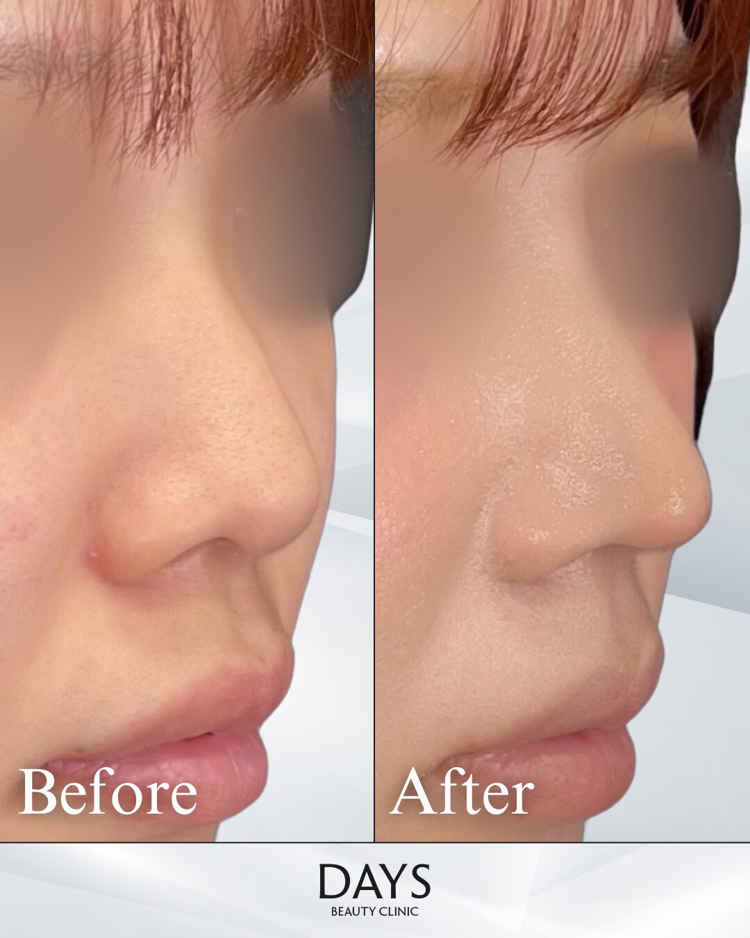 鼻施術　症例　２０代女性