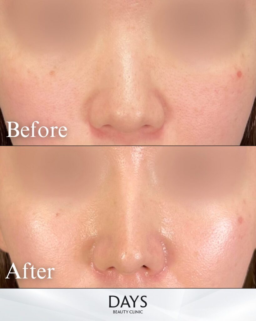 鼻施術　症例　20代女性