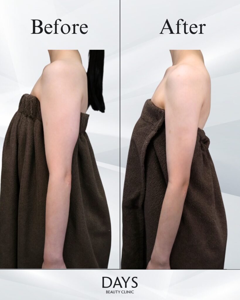 二の腕脂肪吸引　症例　20代女性