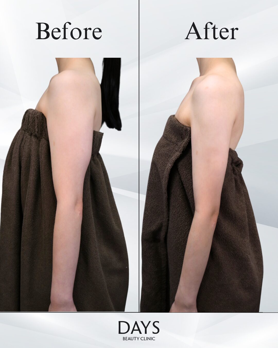 二の腕脂肪吸引 症例 20代女性