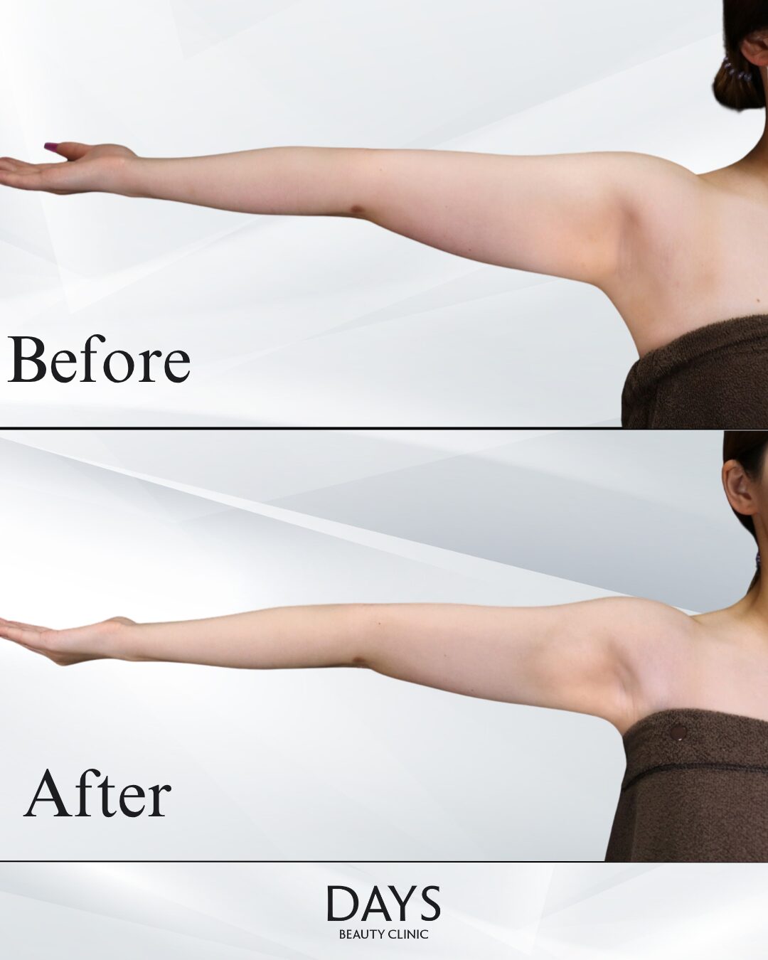 二の腕脂肪吸引 症例 20代女性