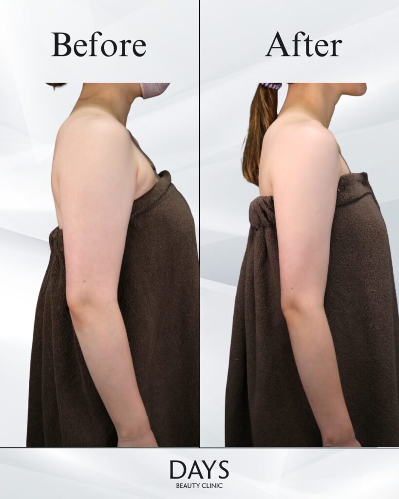 二の腕脂肪吸引　症例　20代女性