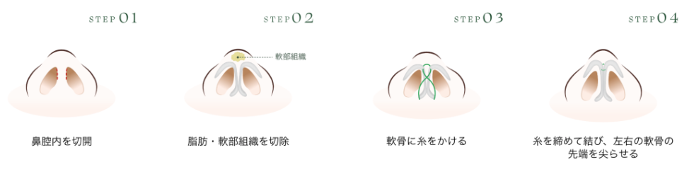 クローズ法施術イメージ