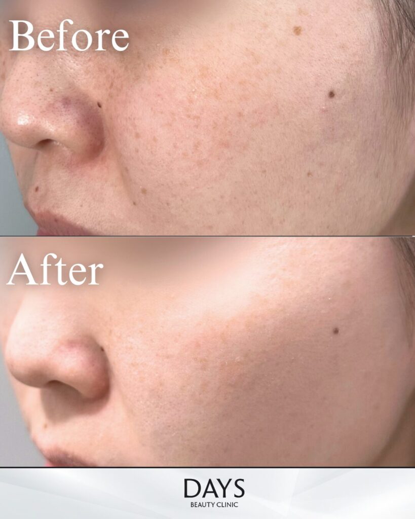 ピコスポット　症例　３０代女性