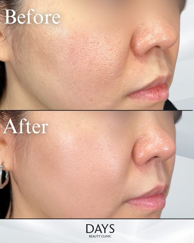 ブレッシング　症例　30代女性