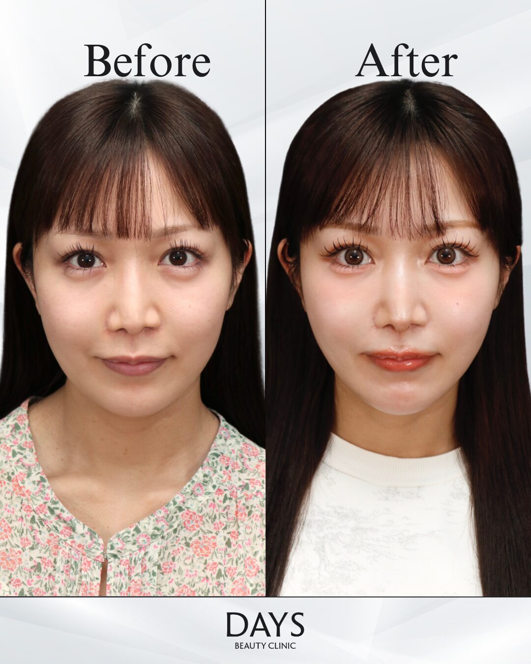 小顔脂肪吸引・糸リフト