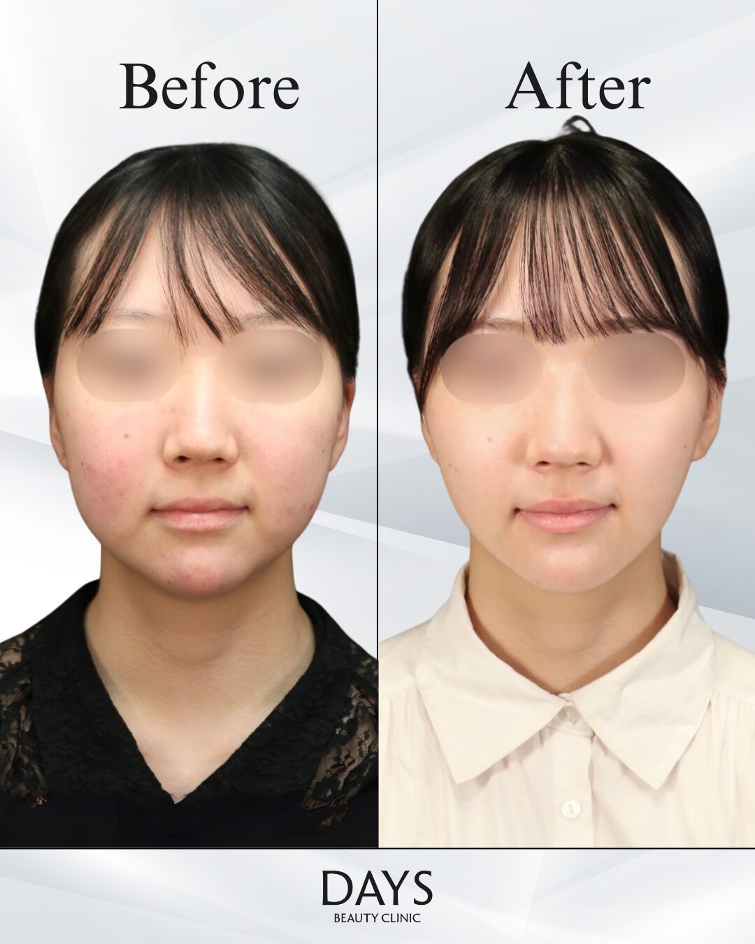 脂肪吸引、バッカル