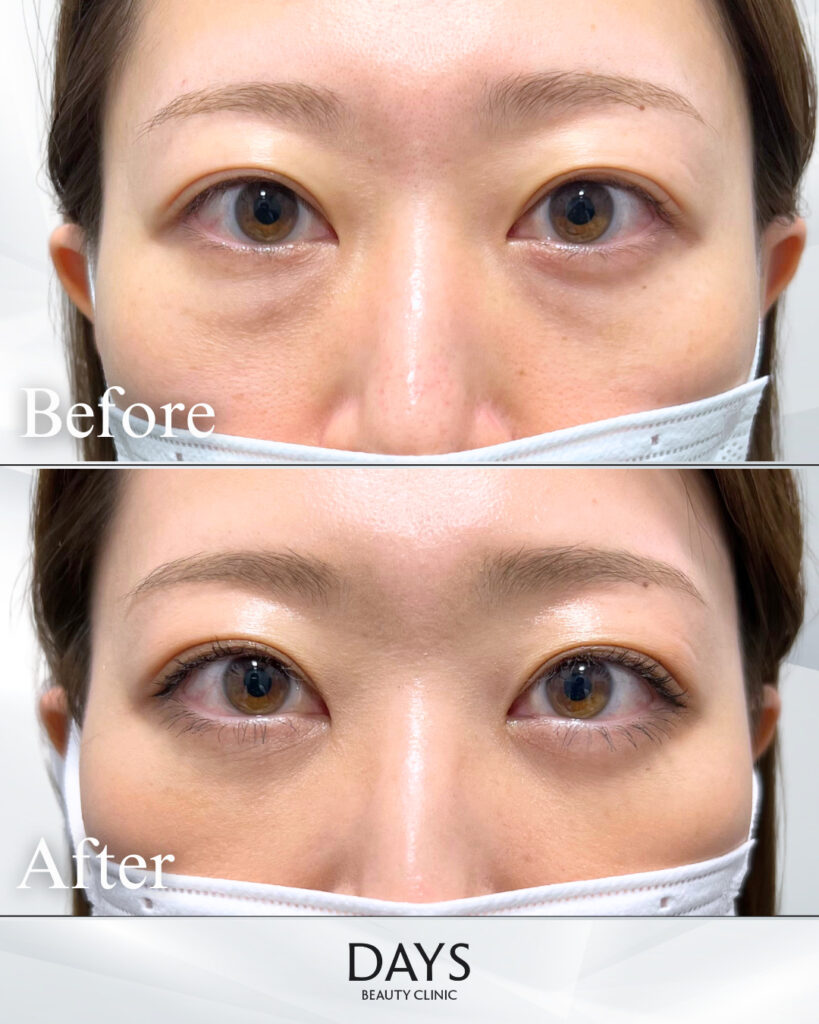 クマ取り　症例　20代女性