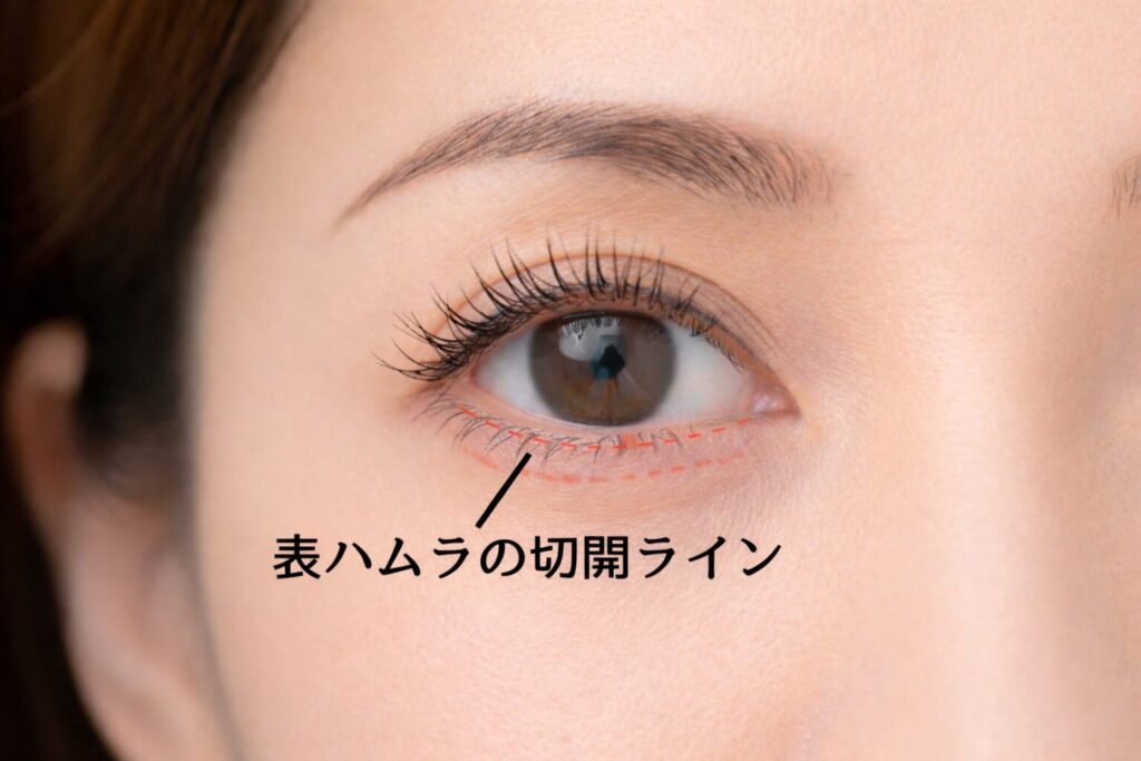 表ハムラとは何?効果・向いている人・裏ハムラとの違いを解説