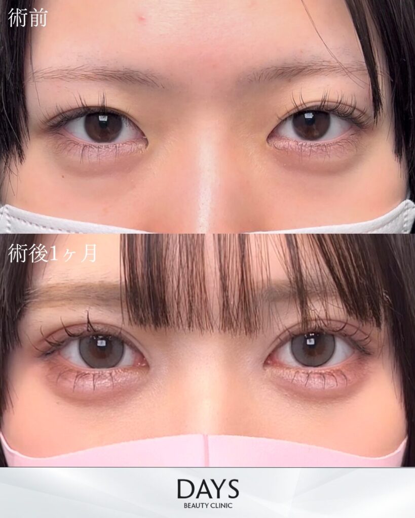 二重埋没　症例　20代女性