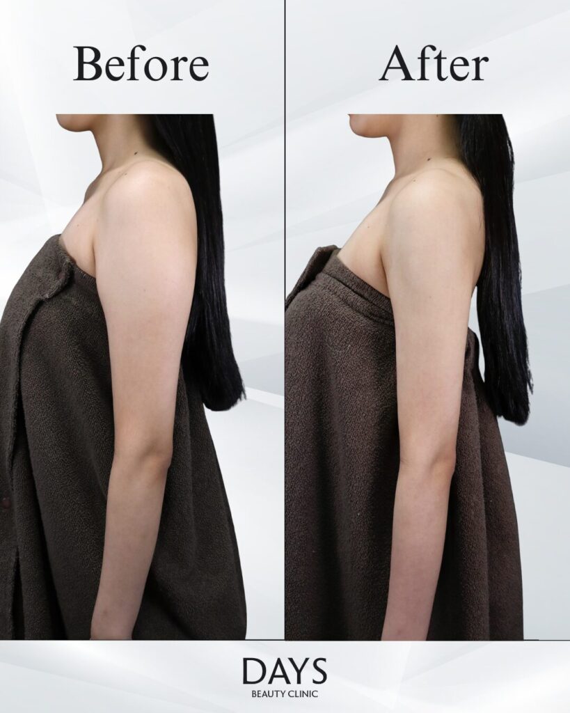 二の腕脂肪吸引症例　20代女性