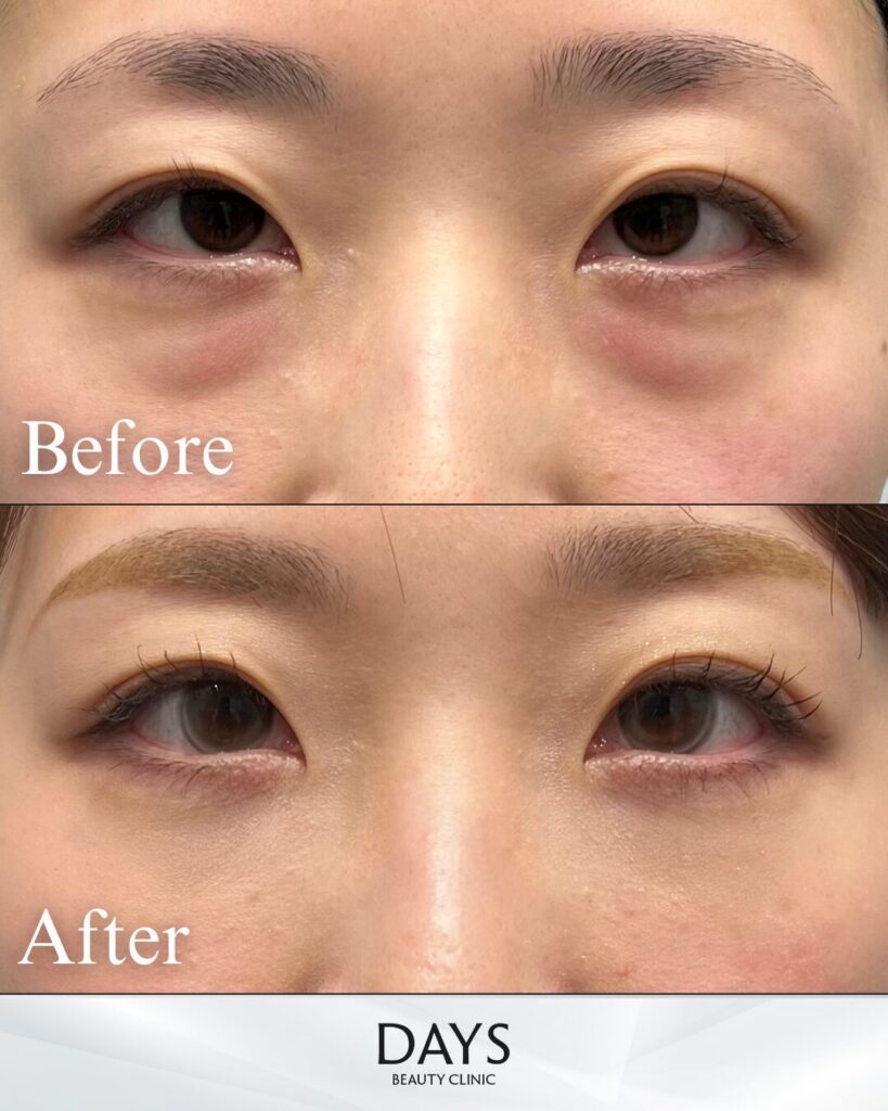 裏ハムラ　症例　30代女性